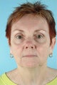 62 Year Old Female Treated for Unwanted Facial Lines