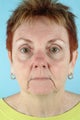 62 Year Old Female Treated for Unwanted Facial Lines