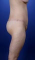 32 year old female gastric bypass patient treated with body liftand buttock auto-augmentation