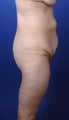 32 year old female gastric bypass patient treated with body liftand buttock auto-augmentation