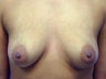Female Patient Before and After Breast Lift