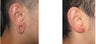 Gauge earlobe hole repair before - Gauge earlobe hole repair 10 days after surgery