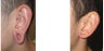 Gauge earlobe hole repair before - Gauge earlobe hole repair 10 days after surgery