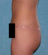 Buttock Augmentation with Circumferential Body Lift