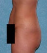Buttock Augmentation with Circumferential Body Lift