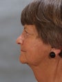 Neck Lift