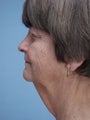 Neck Lift