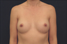Breast Augmentation