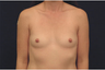Breast Augmentation