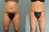58 yr old female Smartlipo abdomen, hips & flanks 6 wks post tx