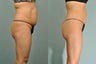 58 yr old female Smartlipo abdomen, hips & flanks 6 wks post tx