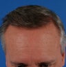 52 year old gentleman who underwent a hair transplant for hair loss