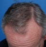 52 year old gentleman who underwent a hair transplant for hair loss