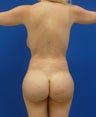 Brazilian Butt Lift via fat transfer