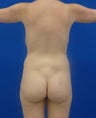 Brazilian Butt Lift via fat transfer