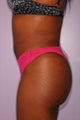 Body Liposuction