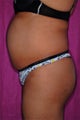 Body Liposuction