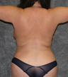 Vaser Liposuction