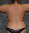 Vaser Liposuction