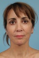 Neck Lift/Face Lift