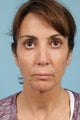 Neck Lift/Face Lift