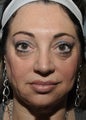 Sculptra to avoid surgery