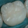 Cavities Repaired with Tooth-Colored Composite