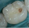 Cavities Repaired with Tooth-Colored Composite