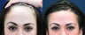 Forehead Reduction Surgery or Hairline Lowering Surgery