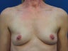 53 Year Old Female with Submuscular Breast Lift