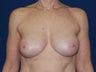 Breast Reconstruction