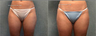 SmartLipo