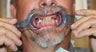 All-on-4 Dental Implants