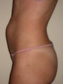 Liposculpting of Abdominals for 42-year old Female Patient
