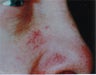 Facial vessels in adults