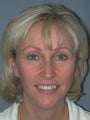 Chin Surgery/Augmentation on 46-year-old