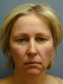 Chin Surgery/Augmentation on 46-year-old