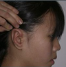 Microtia aka small Ear by Dr Kasrai, Toronto Female Plastic Surgeon