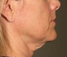Ulthera