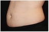 CoolSculpting