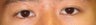 Bilateral Asian Eyelid Surgery