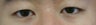 Bilateral Asian Eyelid Surgery