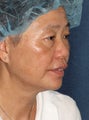 57 year old Asian female with age spots and brown spots