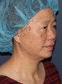 57 year old Asian female with age spots and brown spots