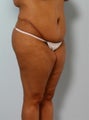 Body Lift