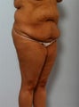 Body Lift