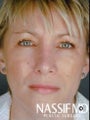 Female Revision Rhinoplasty