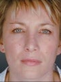 Female Revision Rhinoplasty
