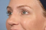 Botox