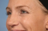 Botox